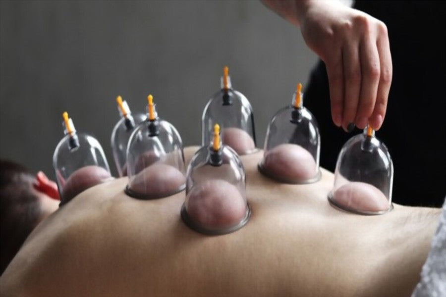 Maximizing the Potential of Cupping Therapy against Fibromyalgia