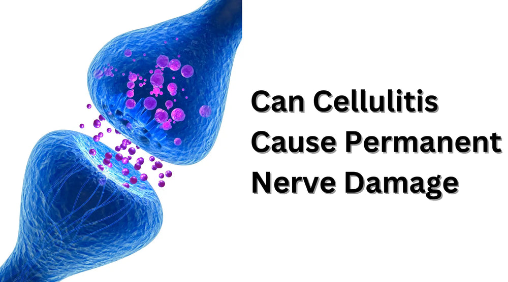 هل يمكن أن يسبب التهاب النسيج الخلوي تلفًا دائمًا للأعصاب؟ 