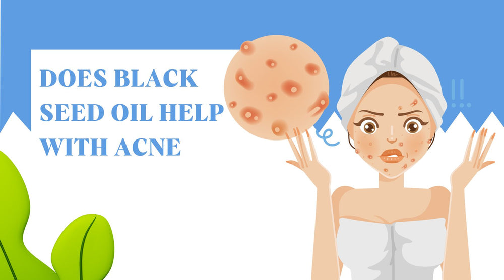 Does Black Seed Oil Help With Acne