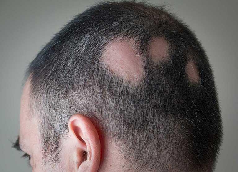 Understanding and Conceptualising Alopecia